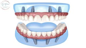 dental implants in india